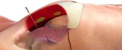 ARS for Needle Decompression